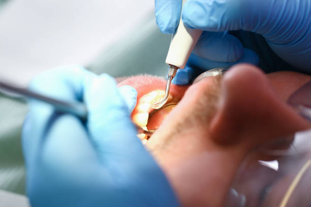 Best Emergency Root Canal Treatment in Glencoe, FL